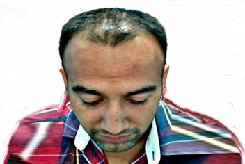 initial condition of patient in type 3 baldness