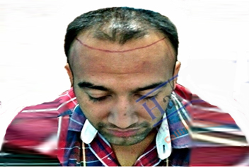 Hairline design on hair transplant recipient of patient in type 3 baldness