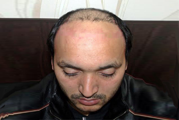initial condition of patient in type 3 baldness