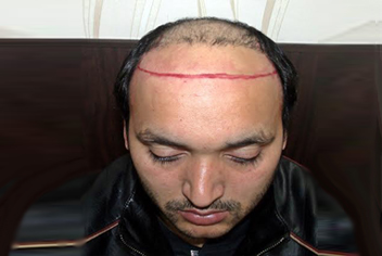 Hairline design on hair transplant recipient of patient in type 3 baldness