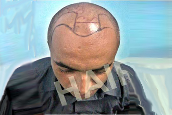 initial condition of patient in type 3 baldness