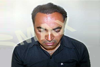 Hairline design on hair transplant recipient of patient in type 4a baldness
