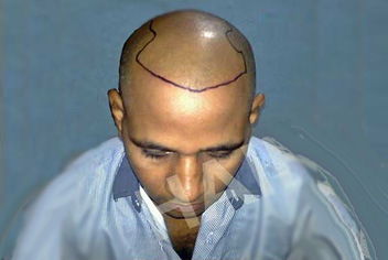 initial condition of patient in type 3 baldness