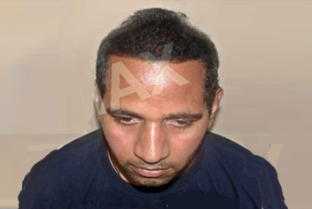 Hairline design on hair transplant recipient of patient in type 3 baldness