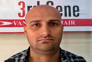 initial condition of patient in type 5 baldness
