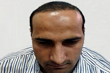 Hairline design on hair transplant recipient of patient in type 3 baldness