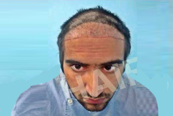 Traction alopecia is hair loss