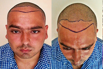 initial condition of patient in type 3 baldness