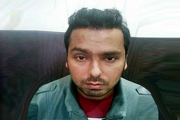 Hairline design on hair transplant recipient of patient in type 3 baldness