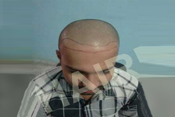 initial condition of patient in type 3 baldness