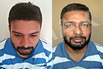 Hairline design on hair transplant recipient of patient in type 3 baldness