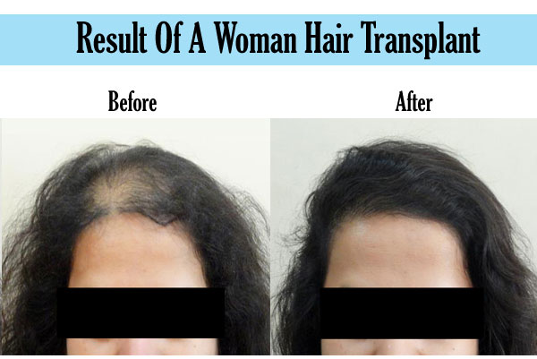 women hair transplant Result