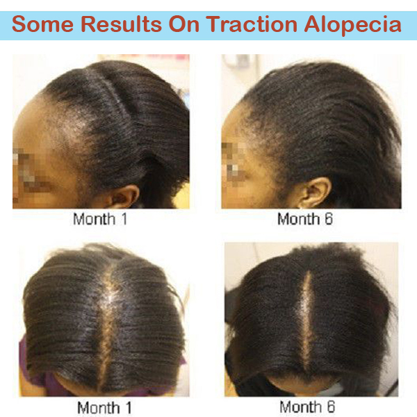 Women traction alopecia hair transplant