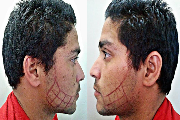 beard hair transplant