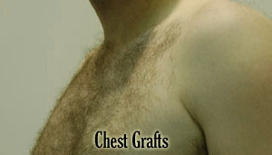 Chest hair