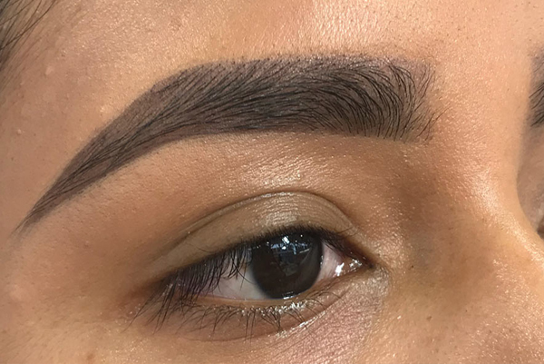 eyebrow hair transplant