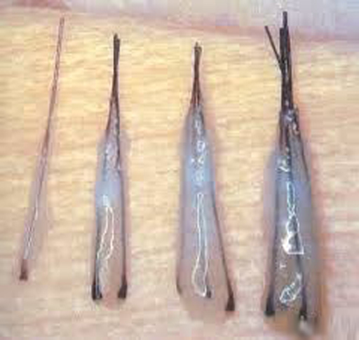 hair transplant donor area healing