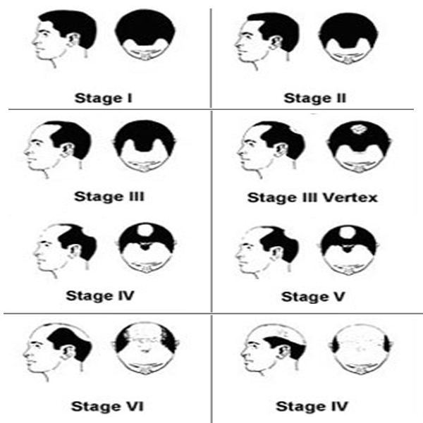 men hair transplant