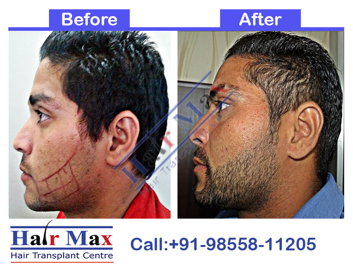 Beard Transplant Result of 3600 grafts (Before After Result) Left side