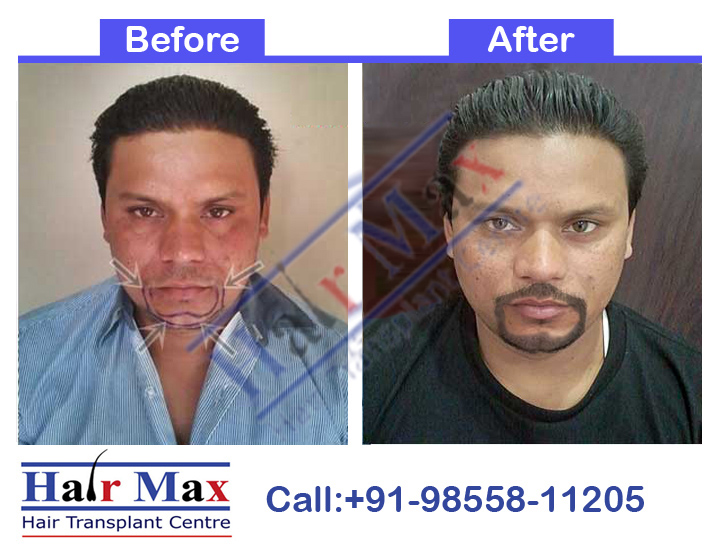French Beard Transplant Result of 1200 grafts