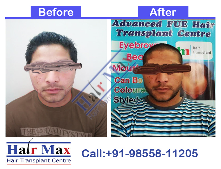 Beard Transplant Result of 3000 grafts