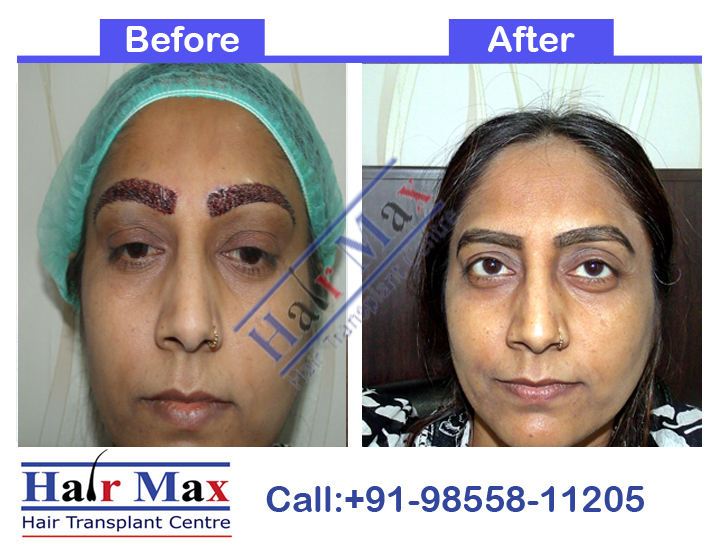 Hair eyebrow transplant