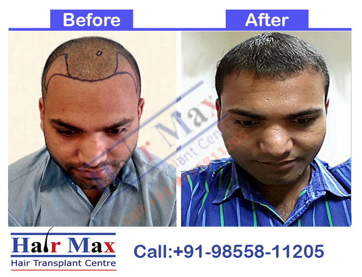 FUE Hair Transplant Result of 2000 grafts (Before After Result)