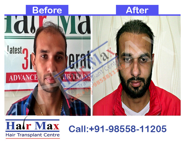 FUE Hair Transplant Result of 4500 grafts (Before After Result)