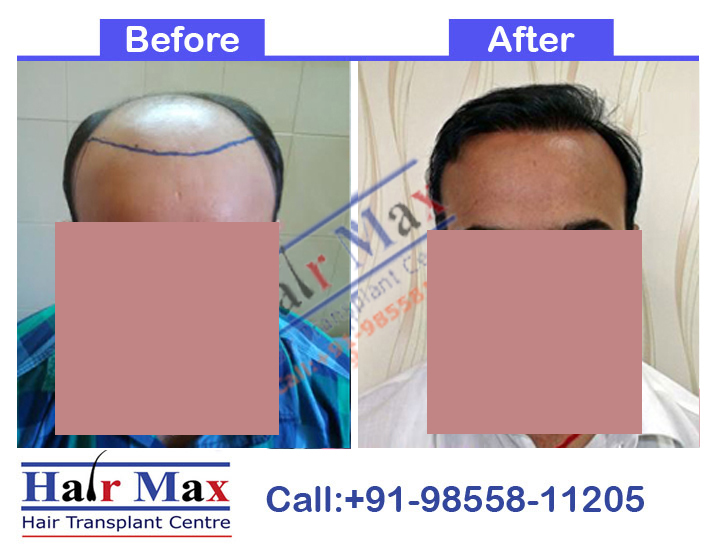 FUE Hair Transplant Result of 5500 grafts (Before After Result)