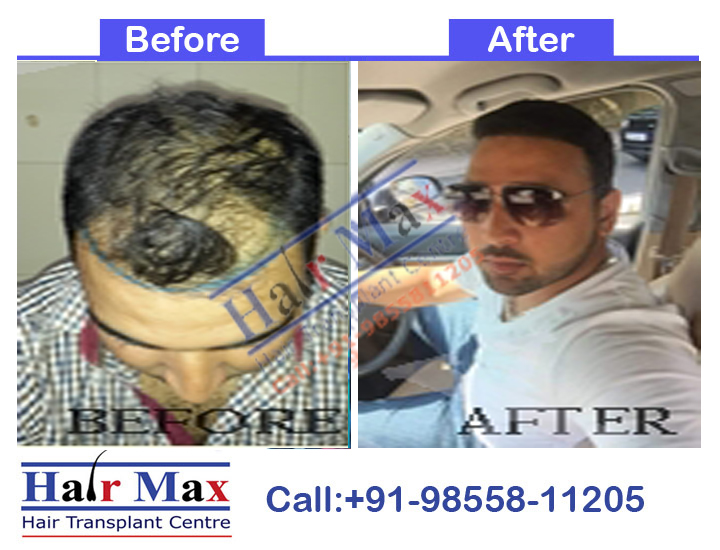 FUE Hair Transplant Result of 4200 grafts (Before After Result)
