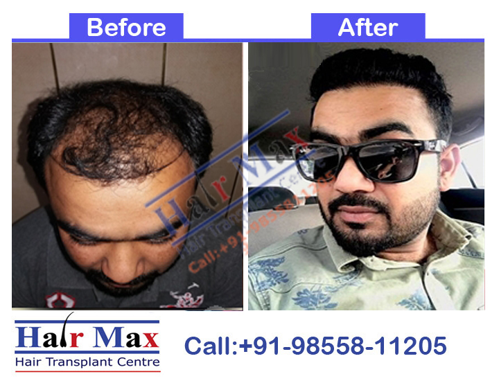 FUE Hair Transplant Result of 4700 grafts (Before After Result)