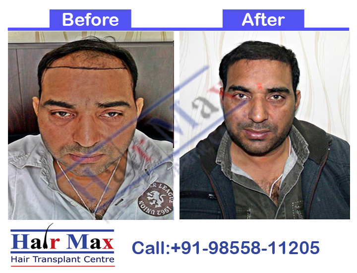 FUE Hair Transplant Result of 3000 grafts (Before After Result)