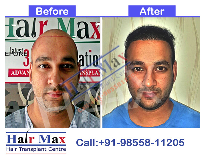 FUE Hair Transplant Result of 5400 grafts (Before After Result)