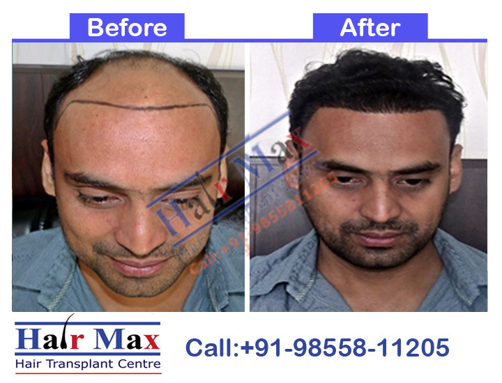 FUE Hair Transplant Result of 5000 grafts (Before After Result)