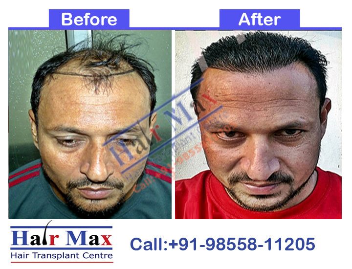 FUE Hair Transplant Result of 4800 grafts (Before After Result)