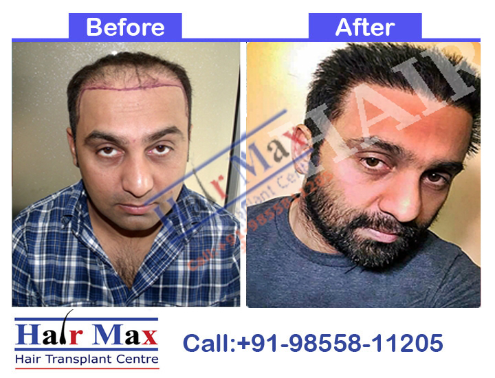 FUE Hair Transplant Result of 4100 grafts (Before After Result)
