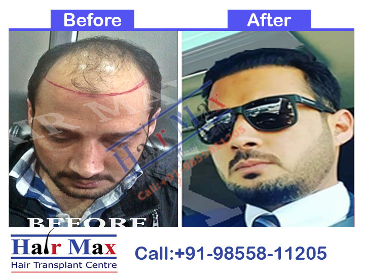 FUE Hair Transplant Result of 5100 grafts (Before After Result)