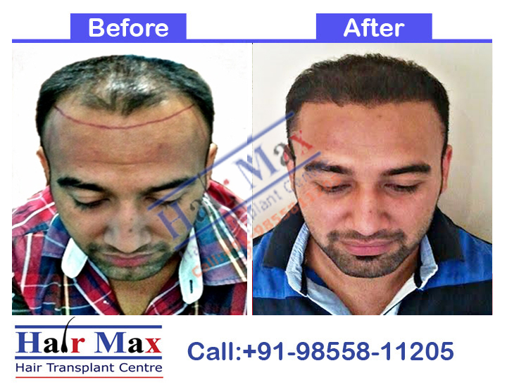 FUE Hair Transplant Result of 3400 grafts (Before After Result)